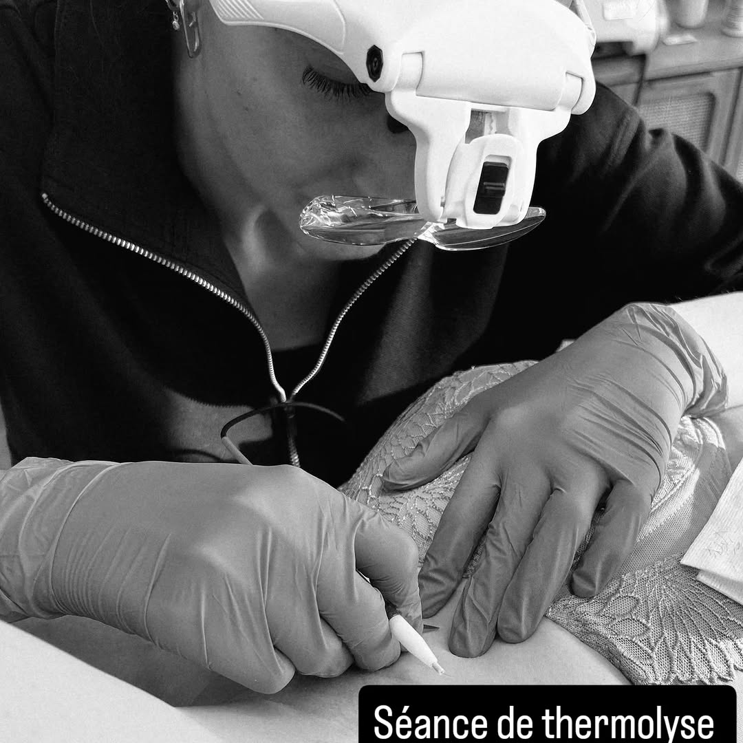 Thermolyse et épilation définitive — Institut LSP Gauchy, proche Saint-Quentin